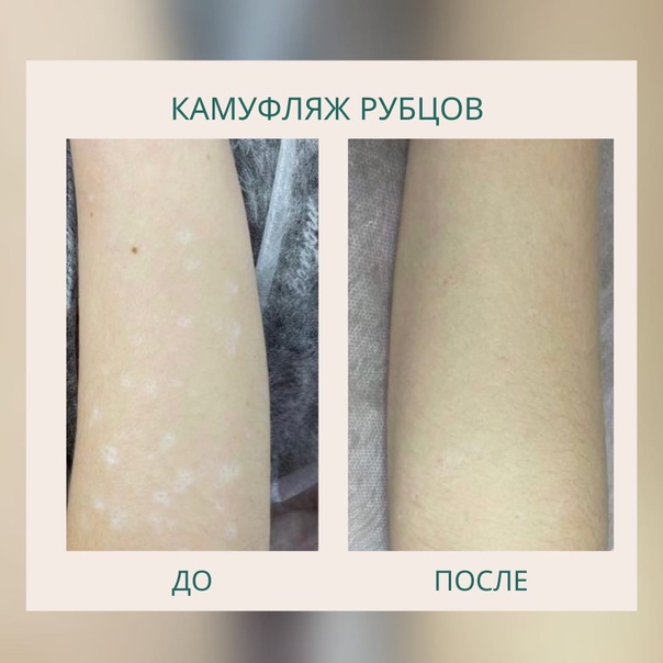 Камуфляж рубцов и шрамов в косметологической клинике АВИ