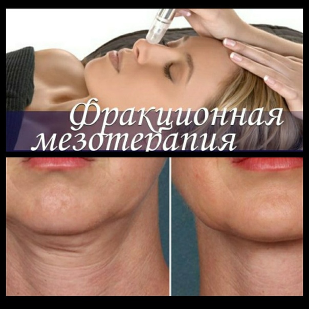 Фракционная мезотерапия в косметологической клинике Красноярска